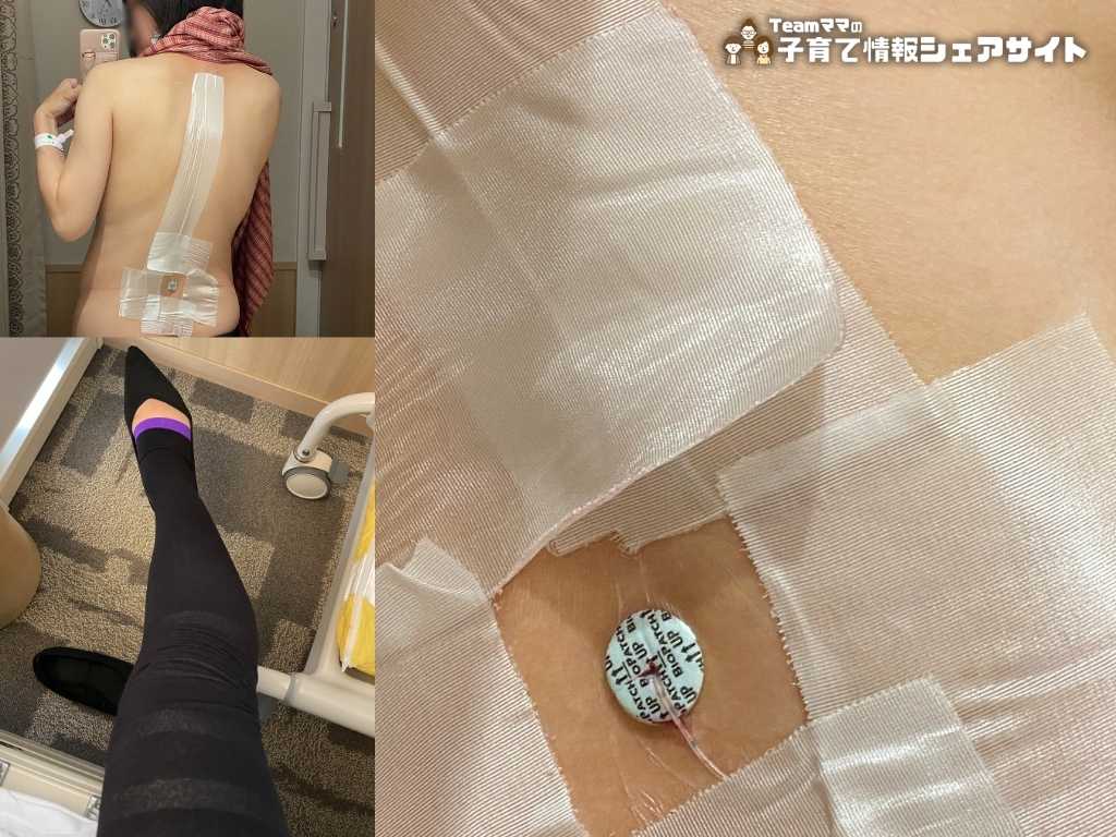 無痛分娩レポート|入院3日目|背中のカテーテル・足のむくみ